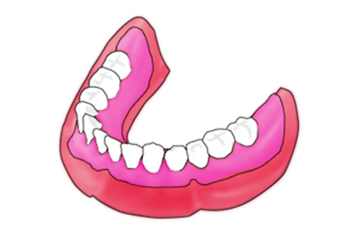 総入れ歯：従来の治療法