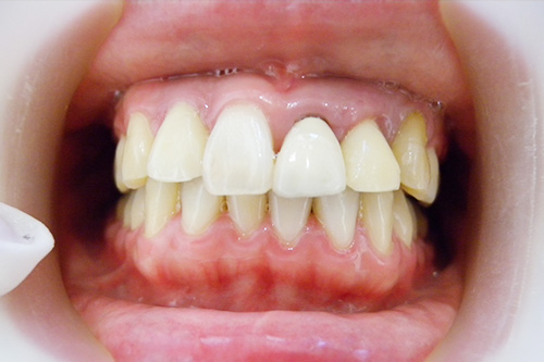 保険の前歯の特徴