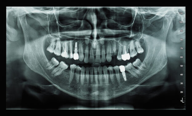 インプラント　歯科CT