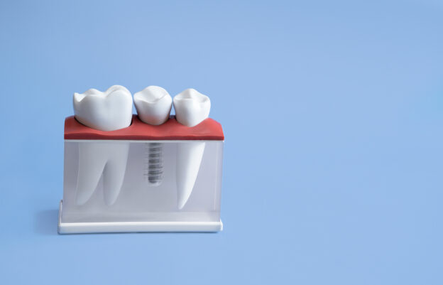 Tooth implantation mockup on a blue background.